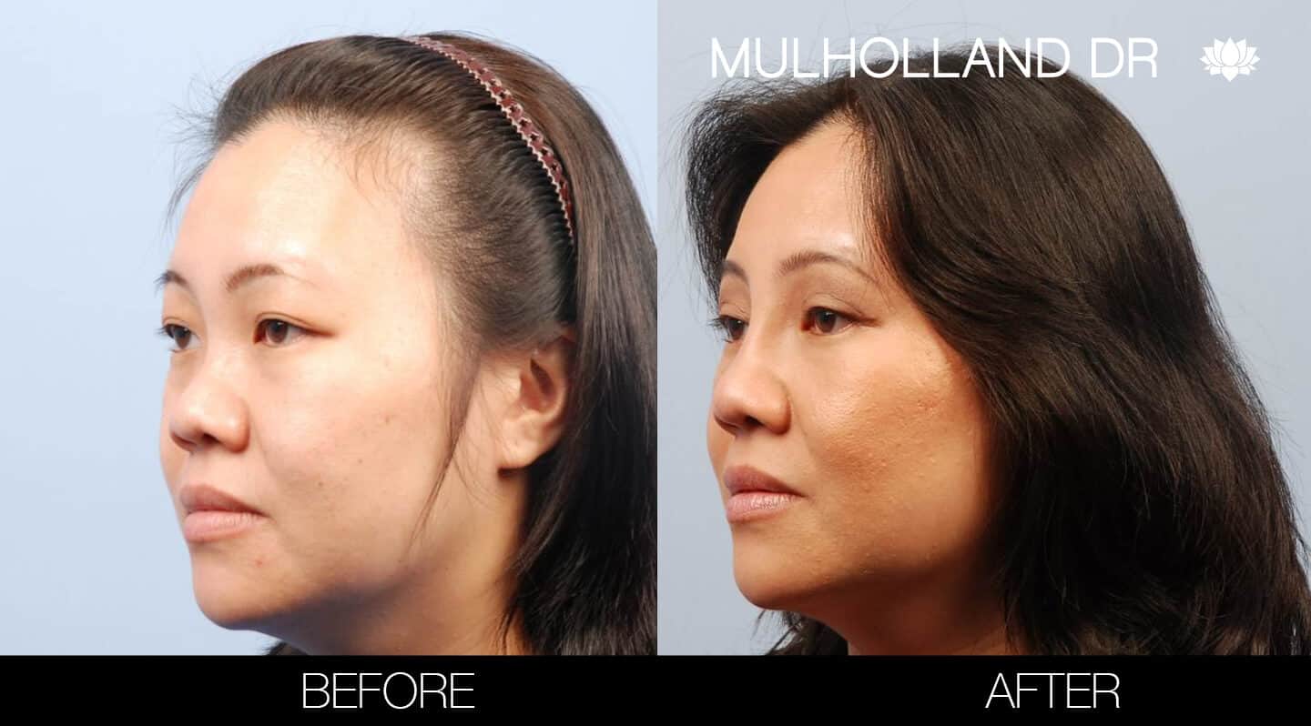 Asian Blepharoplasty - Before and After Gallery – Photo 3