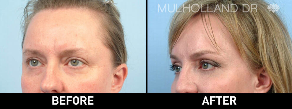 Brow Lift - Before and After Gallery – Photo 3