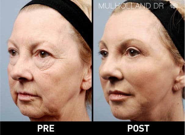 Facial Fat Transfer - Before and After Gallery – Photo 3