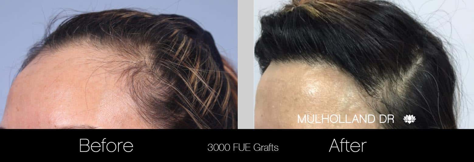 FUE Hair Female - Before and After Gallery – Photo 3