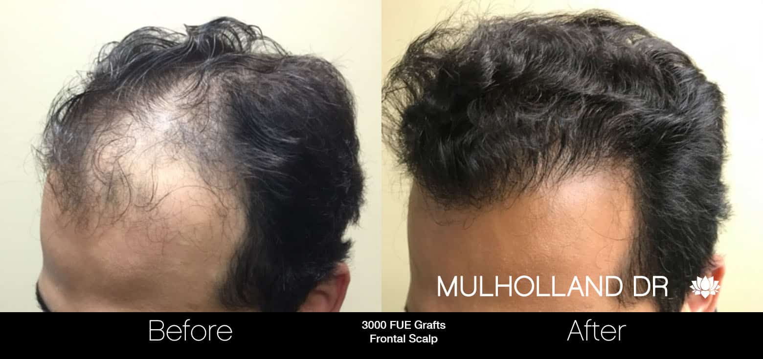 FUE Hair Male - Before and After Gallery – Photo 3
