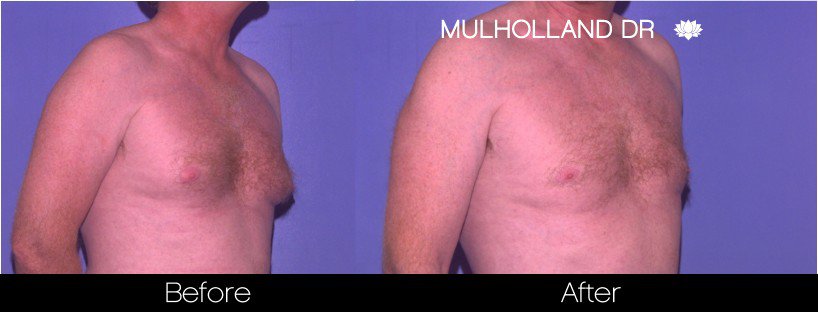 Gynecomastia Surgery (Male Breast Reduction) - Before and After Gallery – Photo 3