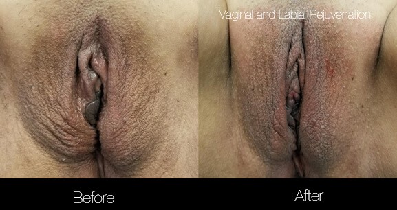 Vaginal Rejuvenation - Before and After Gallery – Photo 3