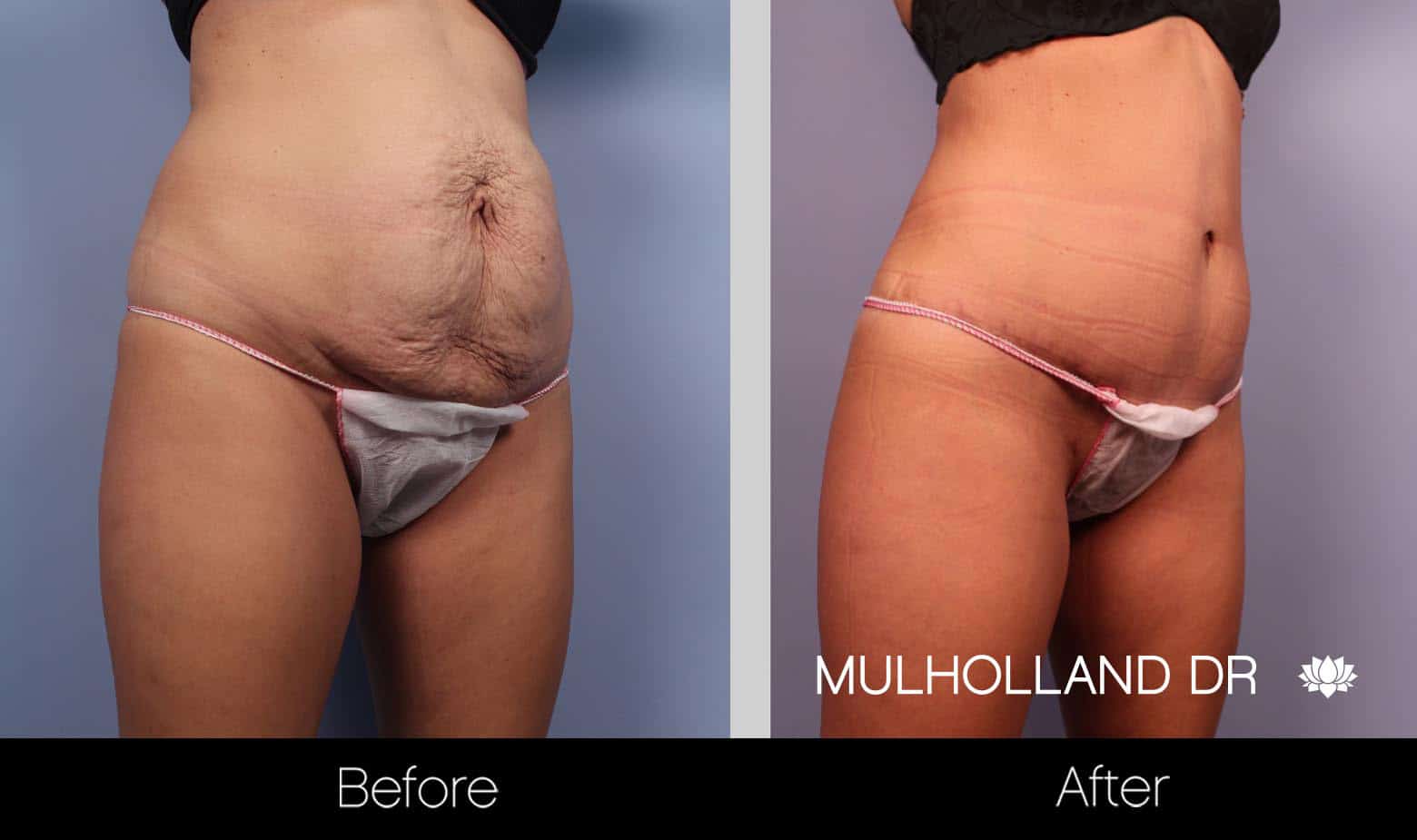Mini Tummy Tuck - Before and After Gallery – Photo 4