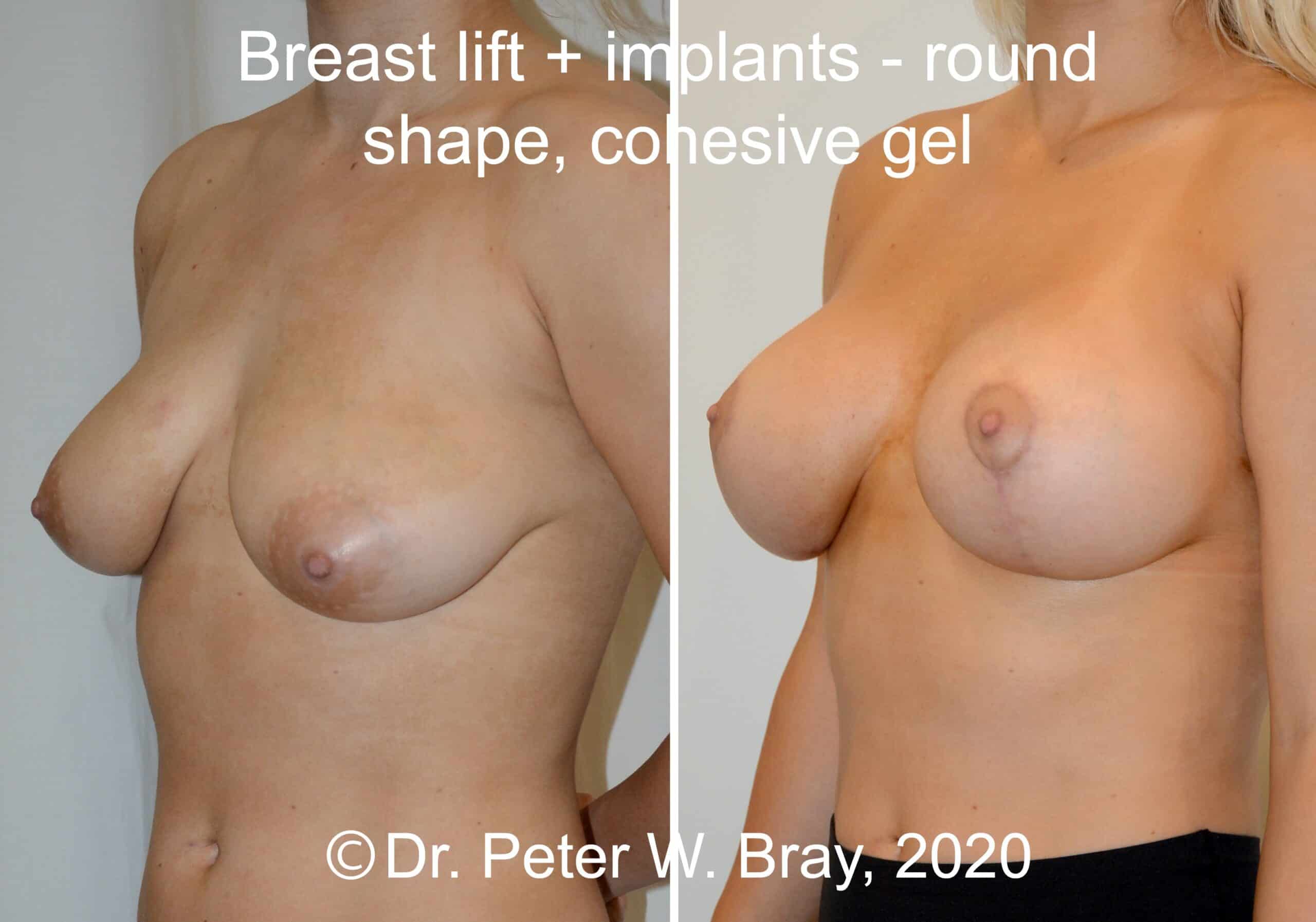 Breast Lift - Before and After Gallery – Photo 4