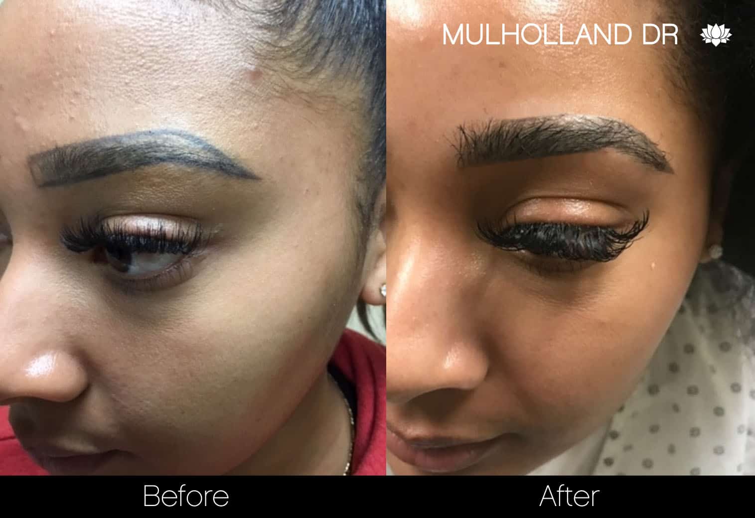 Eyebrows FUE - Before and After Gallery – Photo 4