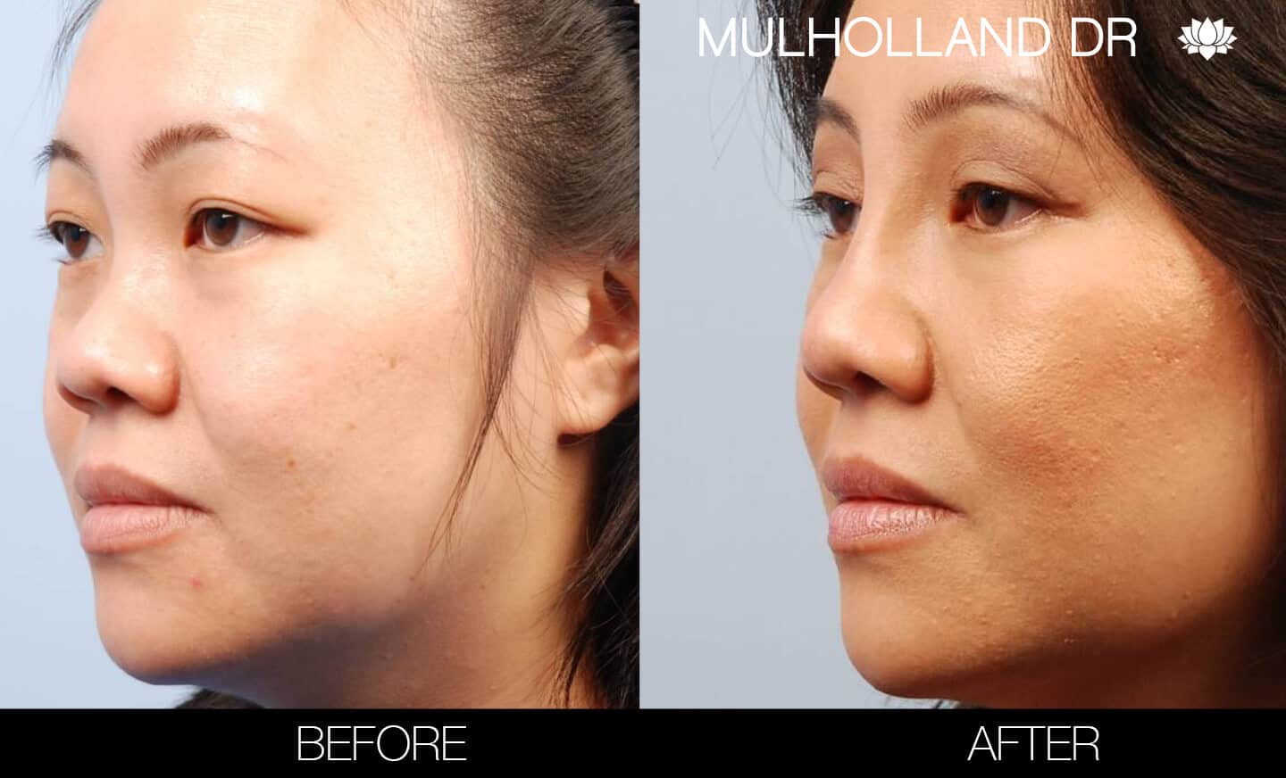 Asian Blepharoplasty - Before and After Gallery – Photo 4