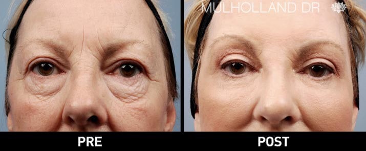 Facial Fat Transfer - Before and After Gallery – Photo 4