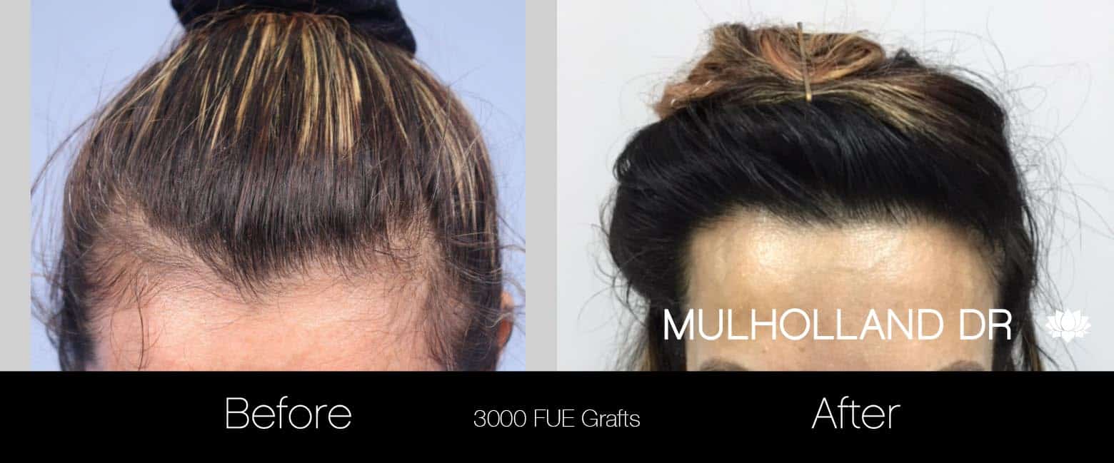 FUE Hair Female - Before and After Gallery – Photo 4