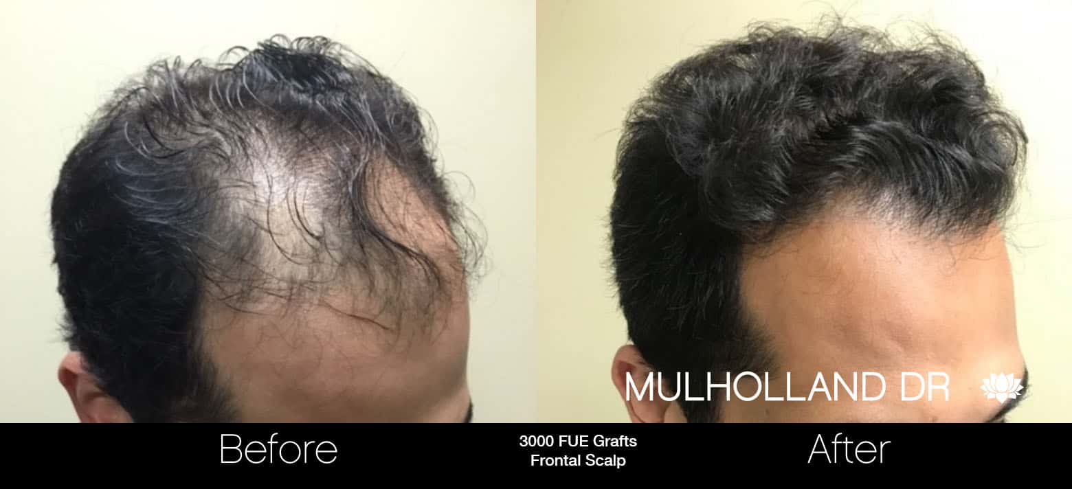 FUE Hair Male - Before and After Gallery – Photo 4