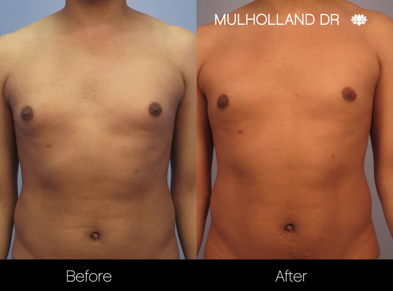 Gynecomastia Surgery (Male Breast Reduction) - Before and After Gallery – Photo 7