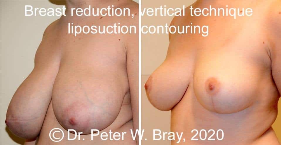 Breast Reduction - Before and After Gallery – Photo 6