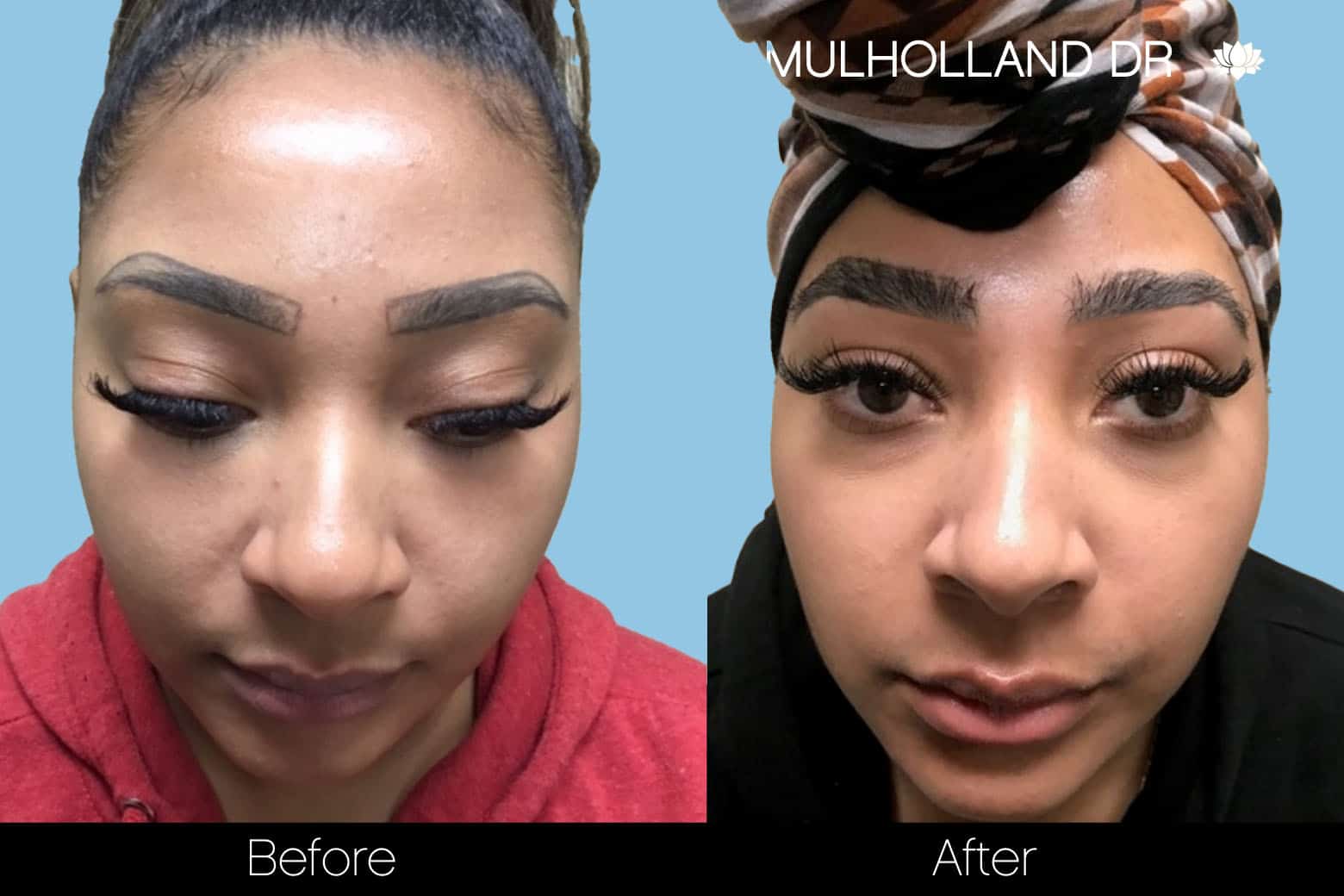 Eyebrows FUE - Before and After Gallery – Photo 5