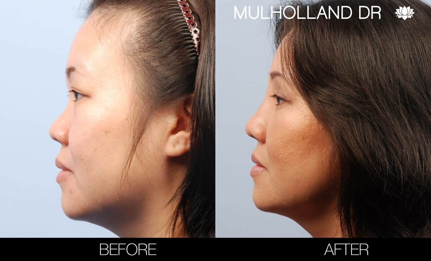 Asian Blepharoplasty - Before and After Gallery – Photo 5