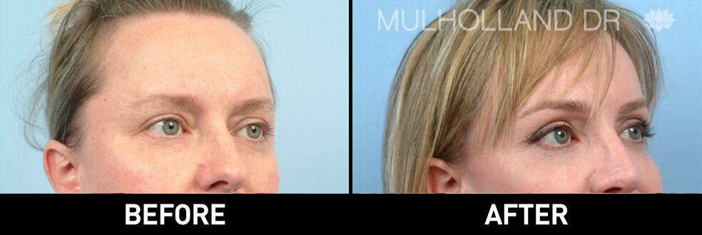 Brow Lift - Before and After Gallery – Photo 5