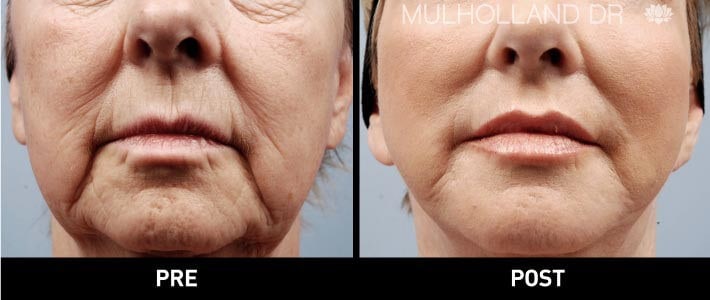 Facial Fat Transfer - Before and After Gallery – Photo 5
