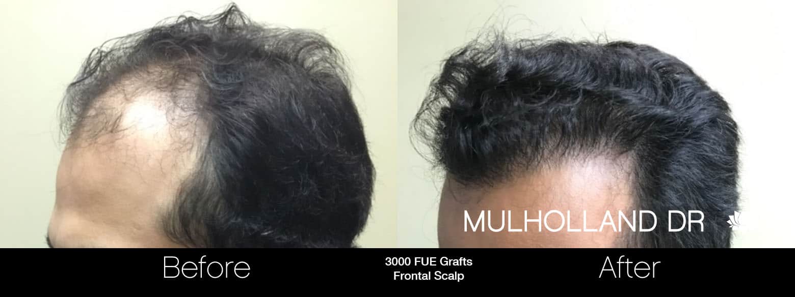FUE Hair Male - Before and After Gallery – Photo 5