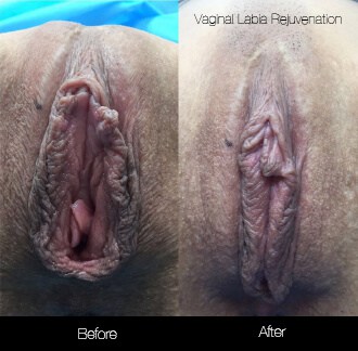 Vaginal Rejuvenation - Before and After Gallery – Photo 5