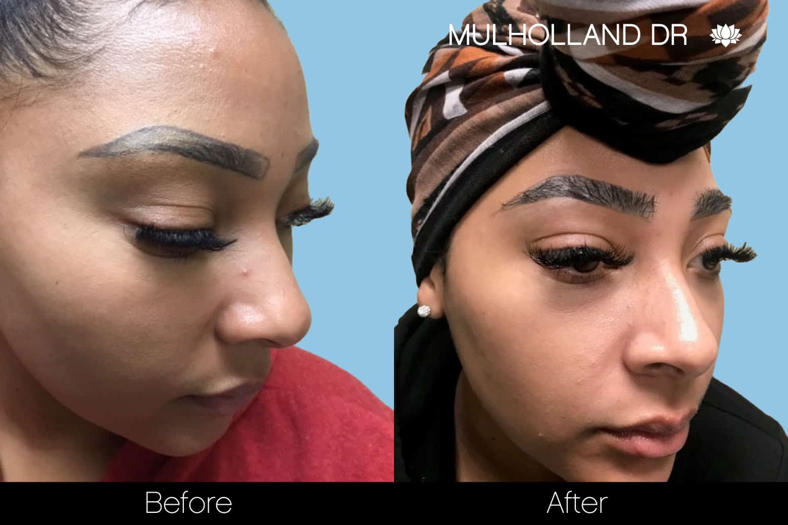 Eyebrows FUE - Before and After Gallery – Photo 6