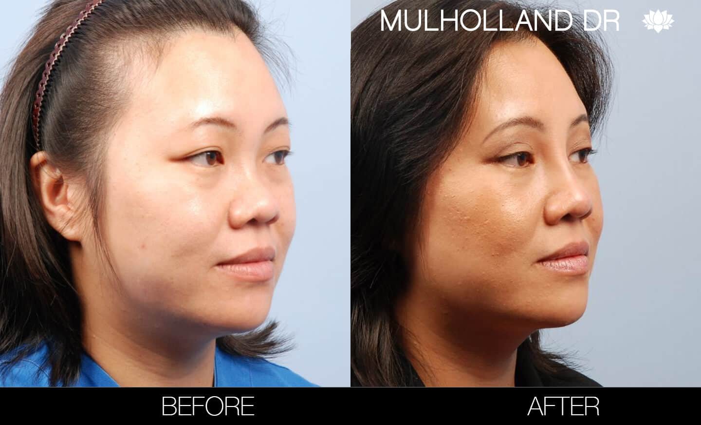 Asian Blepharoplasty - Before and After Gallery – Photo 6