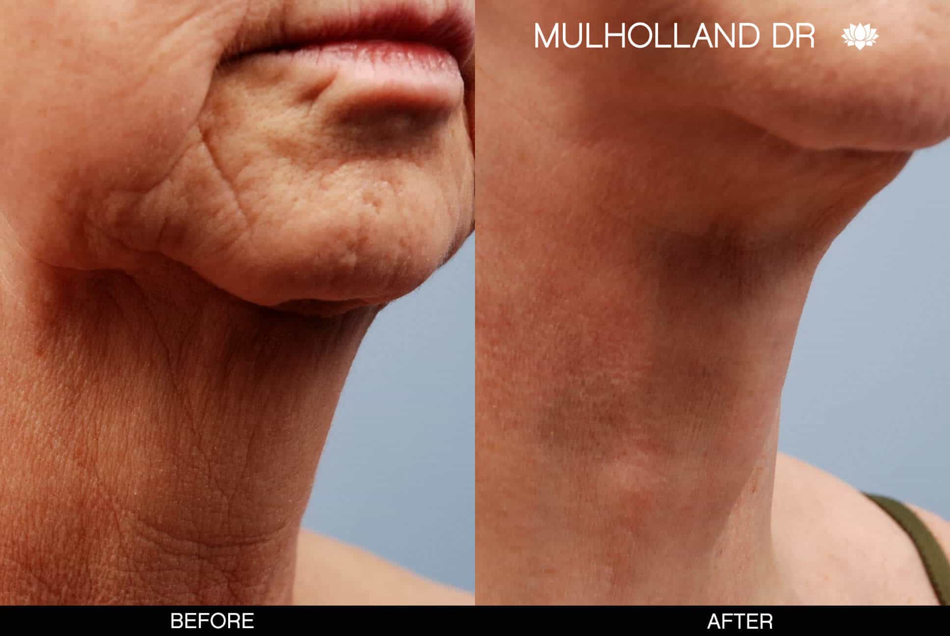 Neck Lift- Before and After Gallery – Photo 6