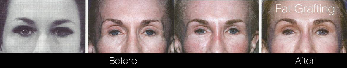 Facial Fat Transfer - Before and After Gallery – Photo 6