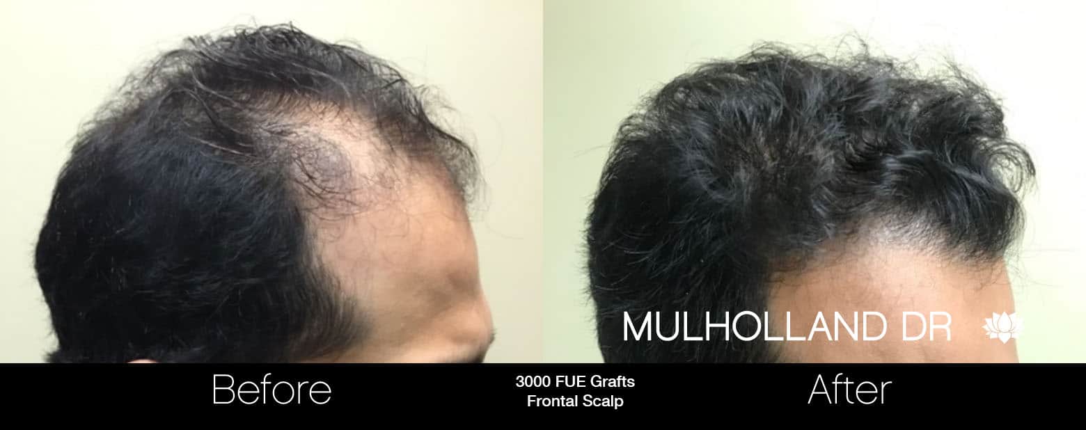 FUE Hair Male - Before and After Gallery – Photo 6