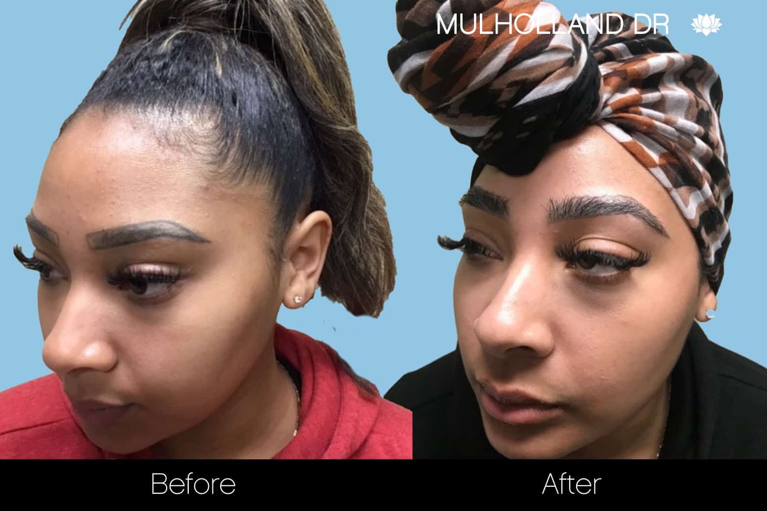 Eyebrows FUE - Before and After Gallery – Photo 7