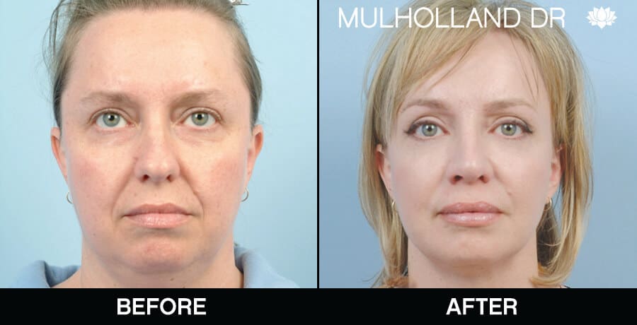 Neck Lift- Before and After Gallery – Photo 7