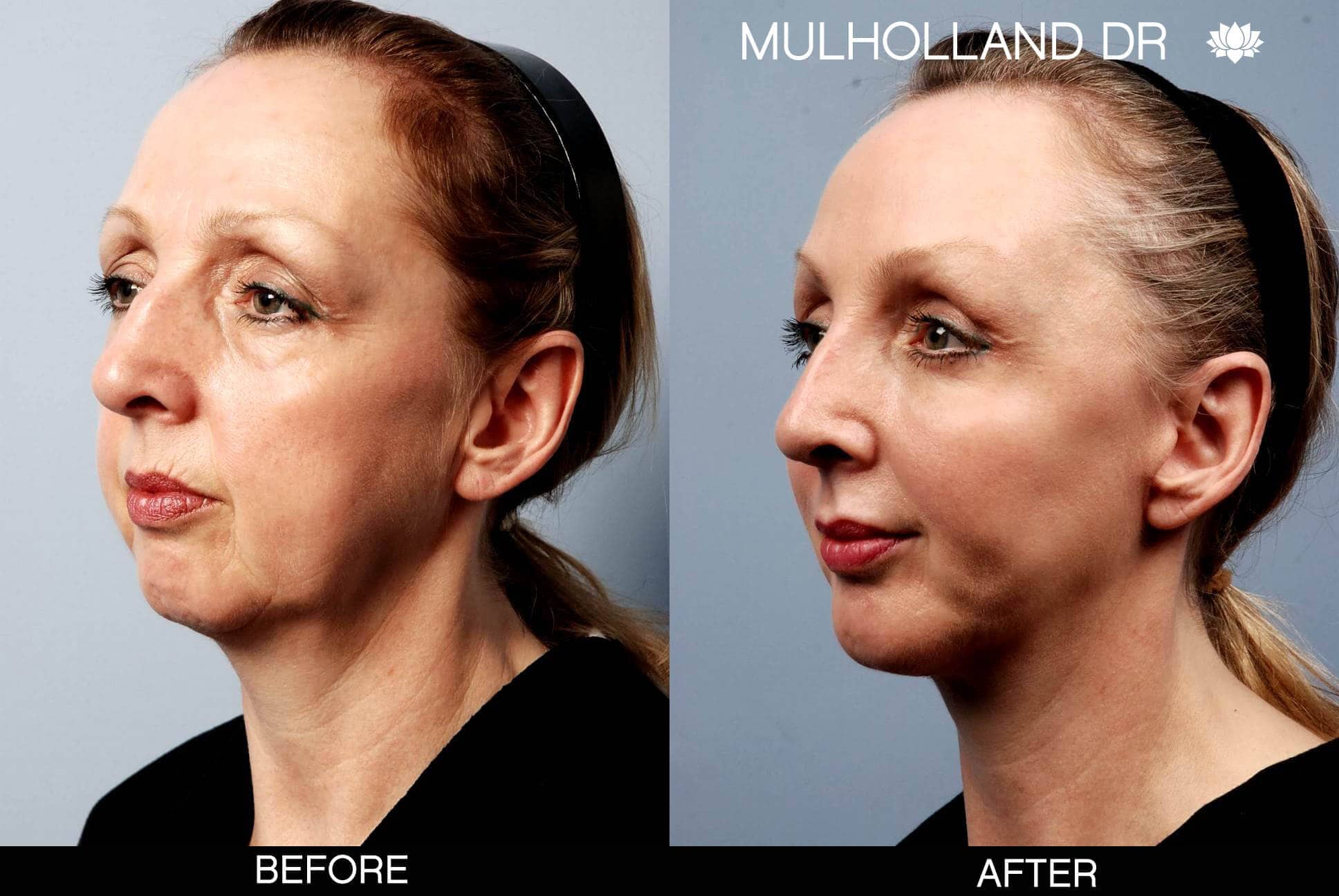 Facial Fat Transfer - Before and After Gallery – Photo 9