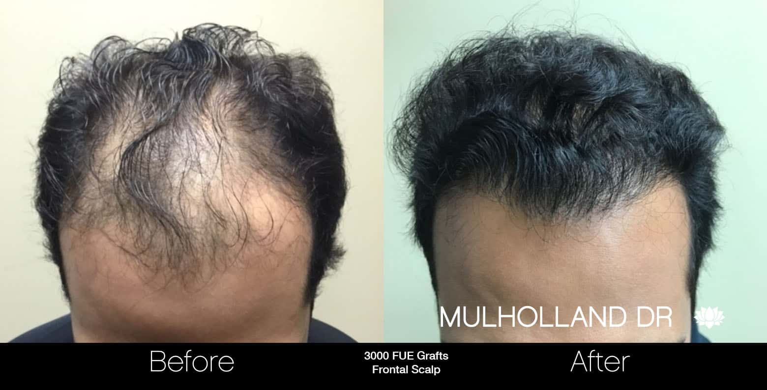 FUE Hair Male - Before and After Gallery – Photo 7