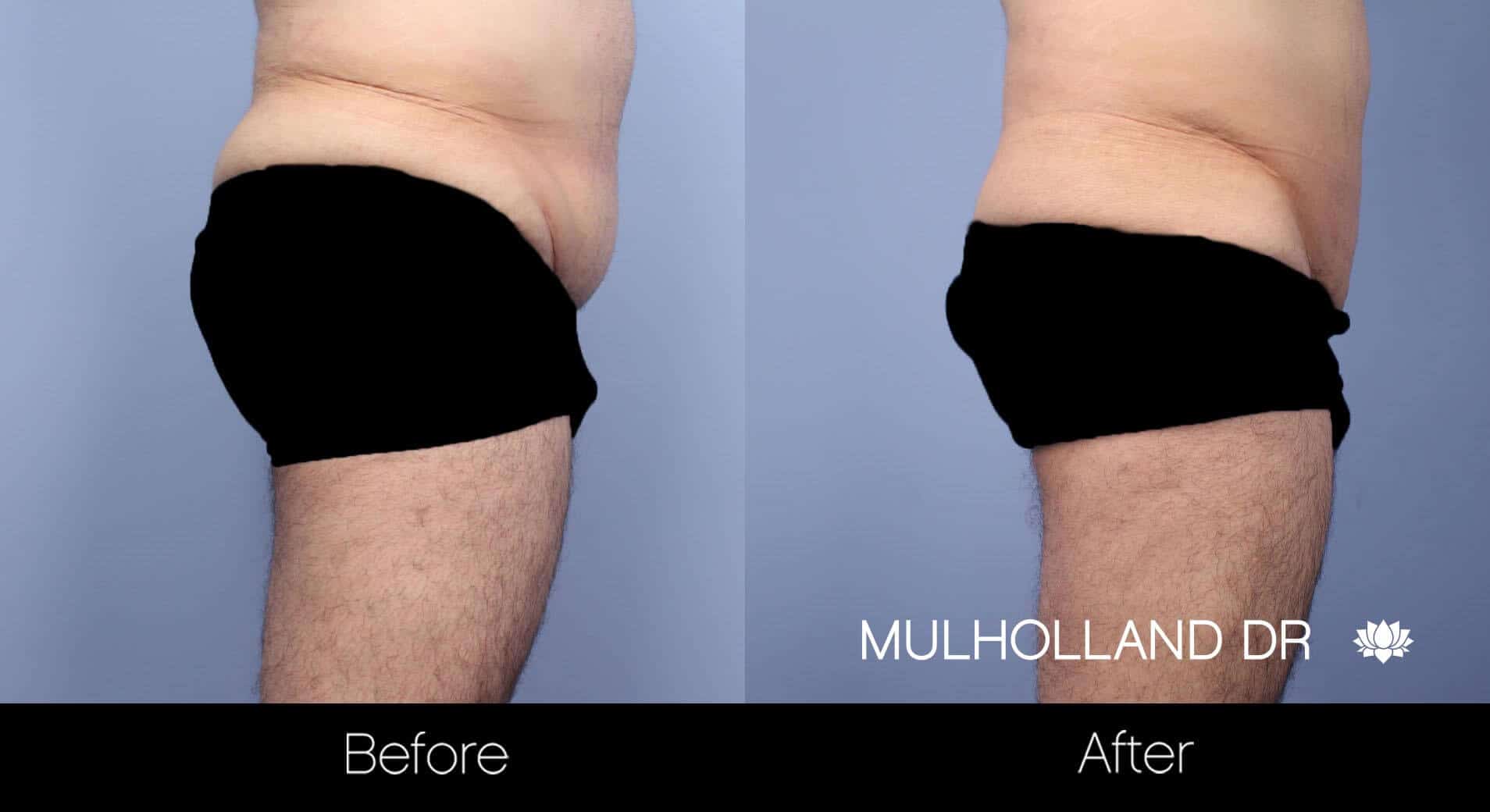 Male Tummy Tuck (Belt Lipectomy) - Before and After Gallery – Photo 8