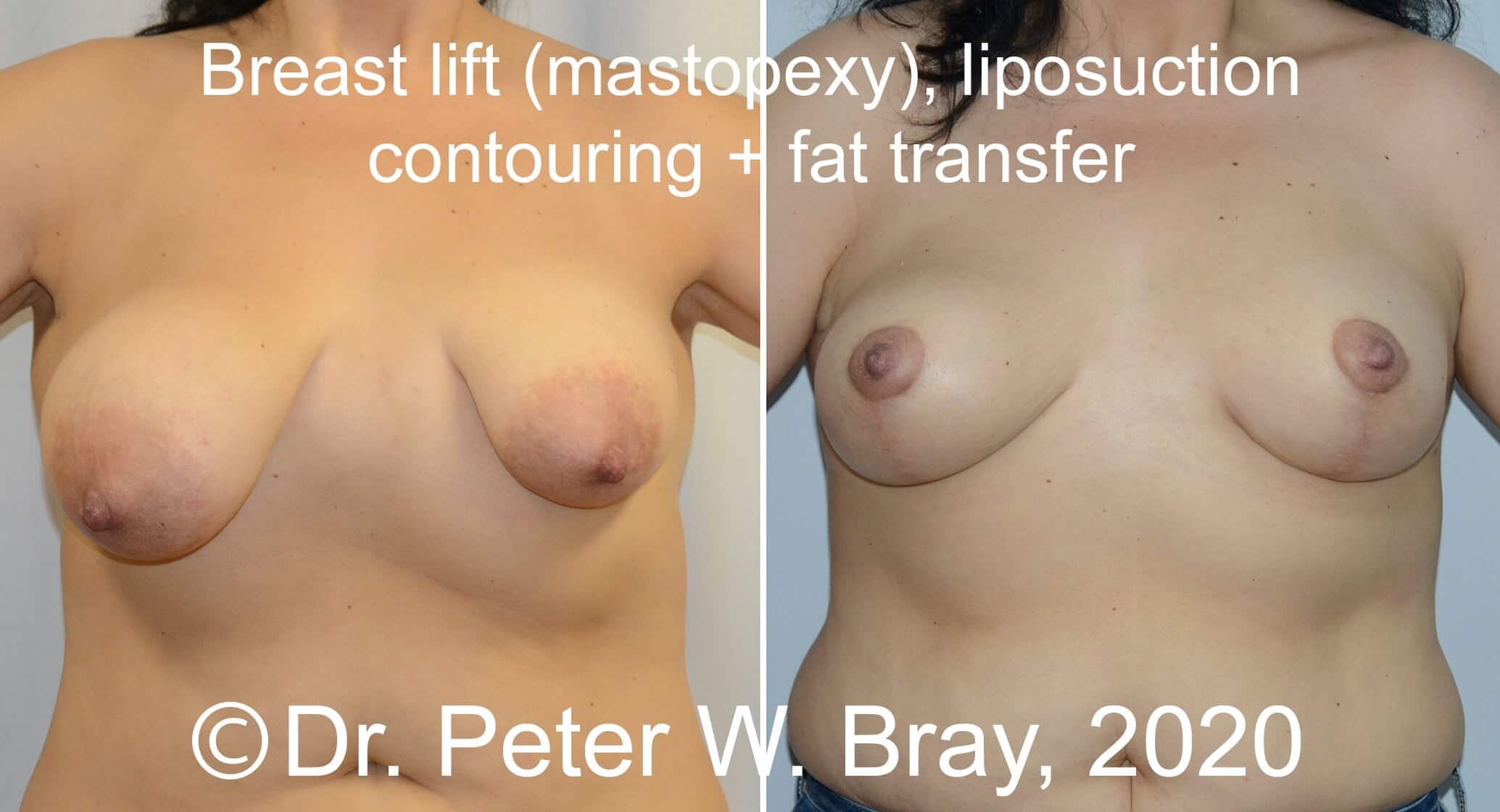 Breast Reduction - Before and After Gallery – Photo 8