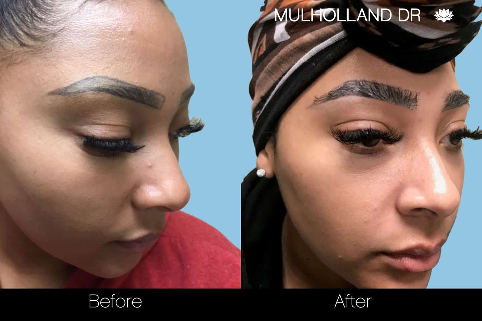 Eyebrows FUE - Before and After Gallery – Photo 8