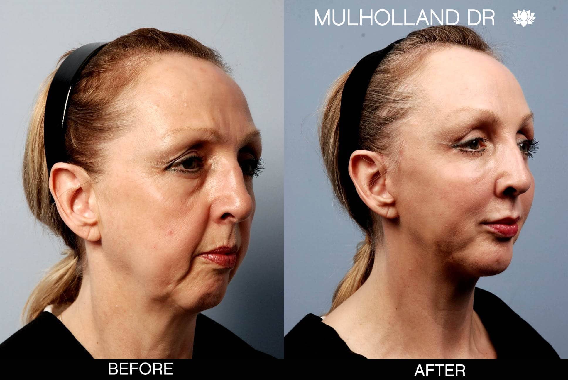 Facial Fat Transfer - Before and After Gallery – Photo 10