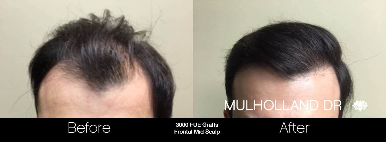 FUE Hair Male - Before and After Gallery – Photo 8
