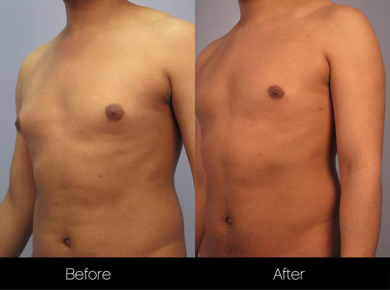 Gynecomastia Surgery (Male Breast Reduction) - Before and After Gallery – Photo 11