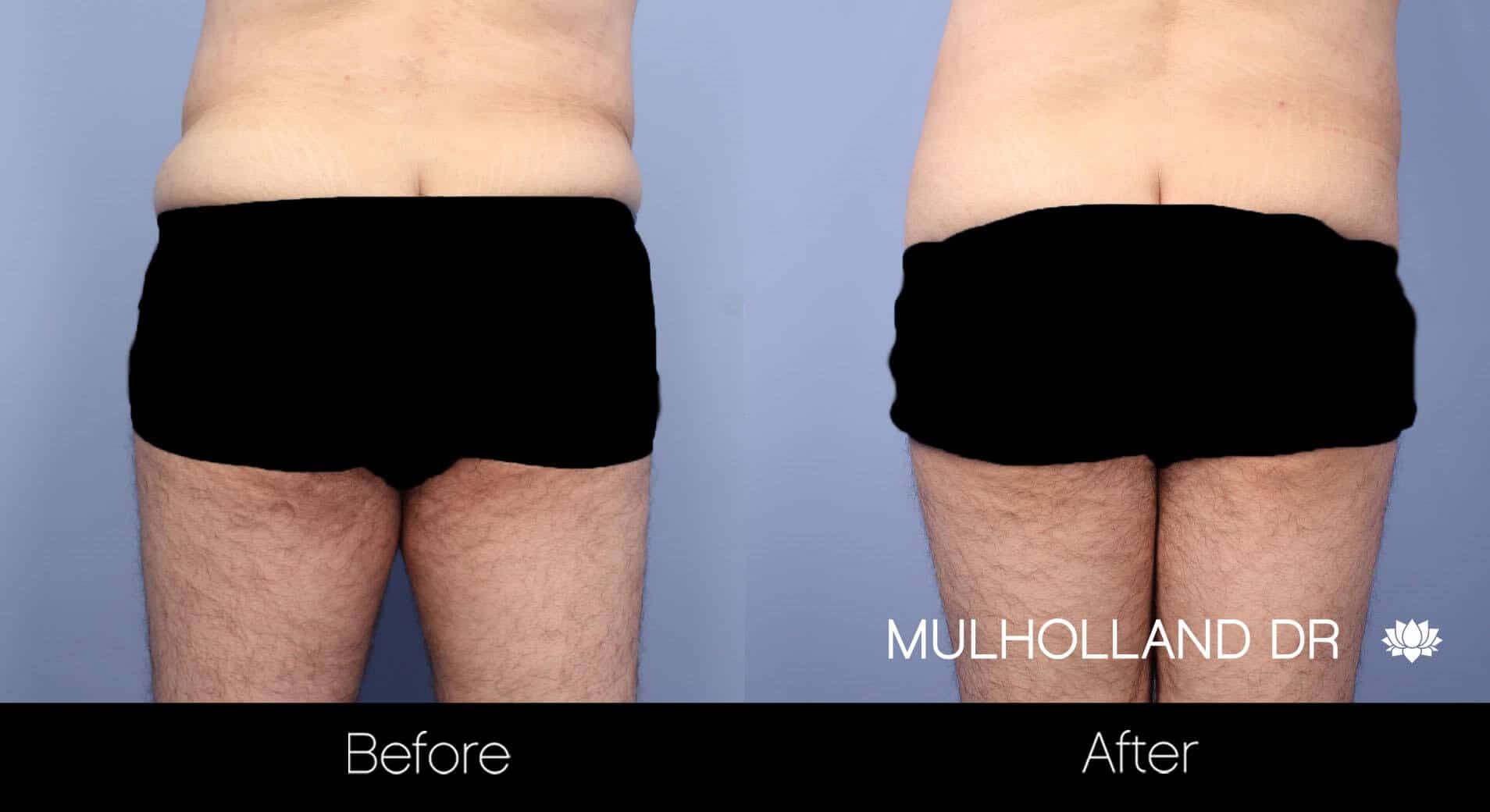 Male Tummy Tuck (Belt Lipectomy) - Before and After Gallery – Photo 9