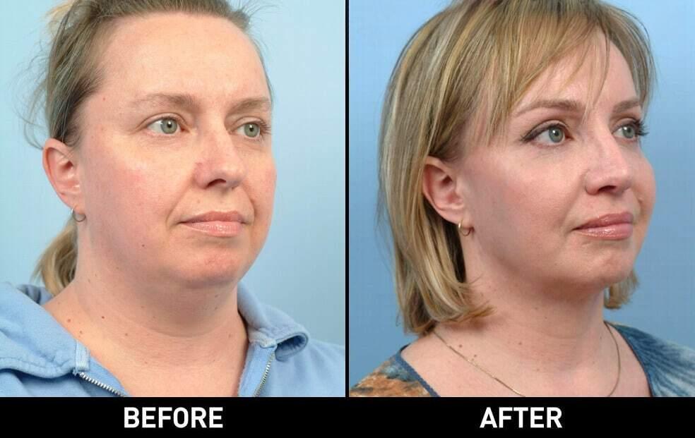 Neck Lift Patient 2 Spamedica