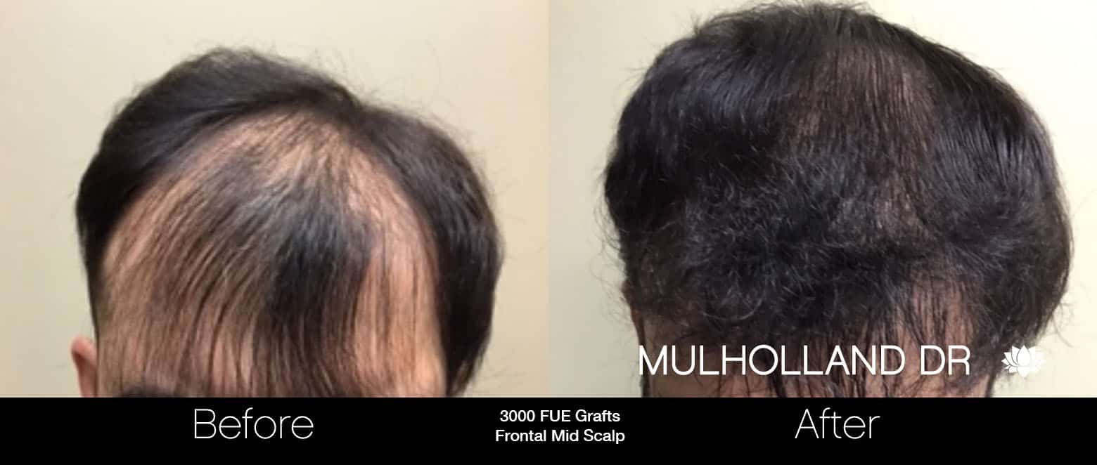 FUE Hair Male - Before and After Gallery – Photo 9