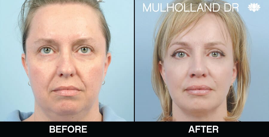 Cheek Lift - Before and After Gallery – Photo 6
