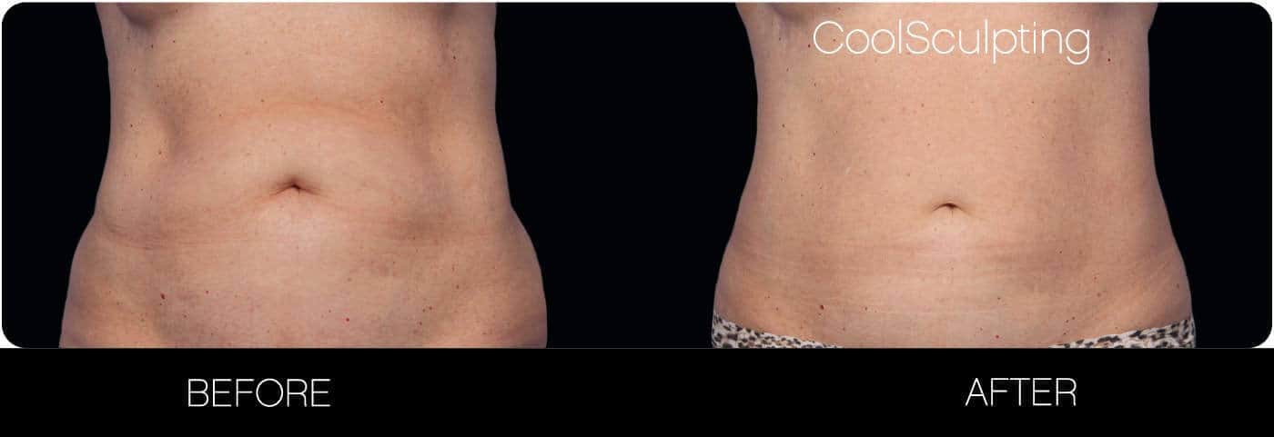 CoolSculpting - Before and After Gallery – Photo 11