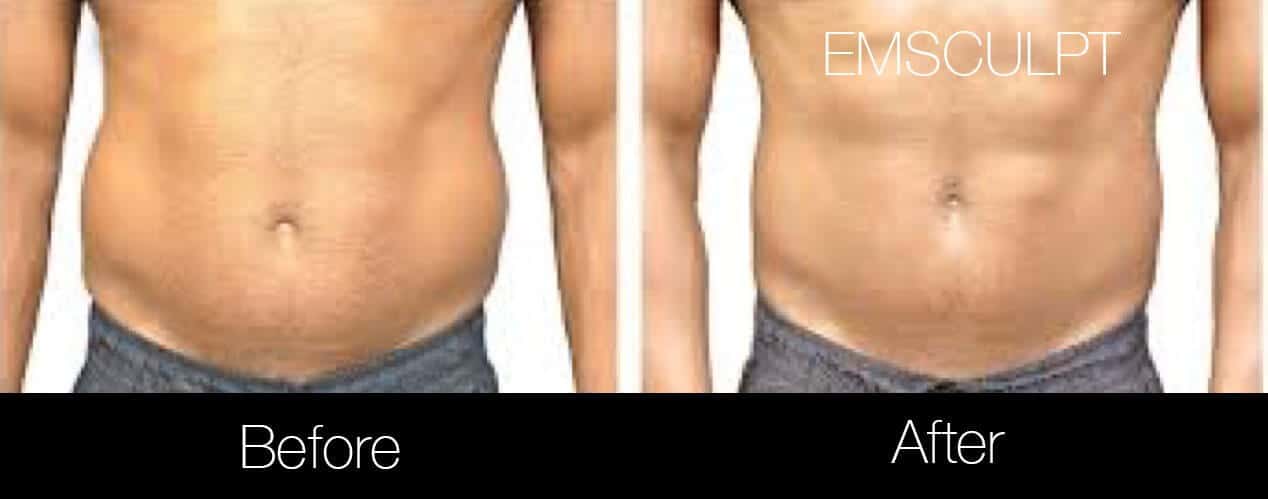 Emsculpt - Before and After Gallery – Photo 11