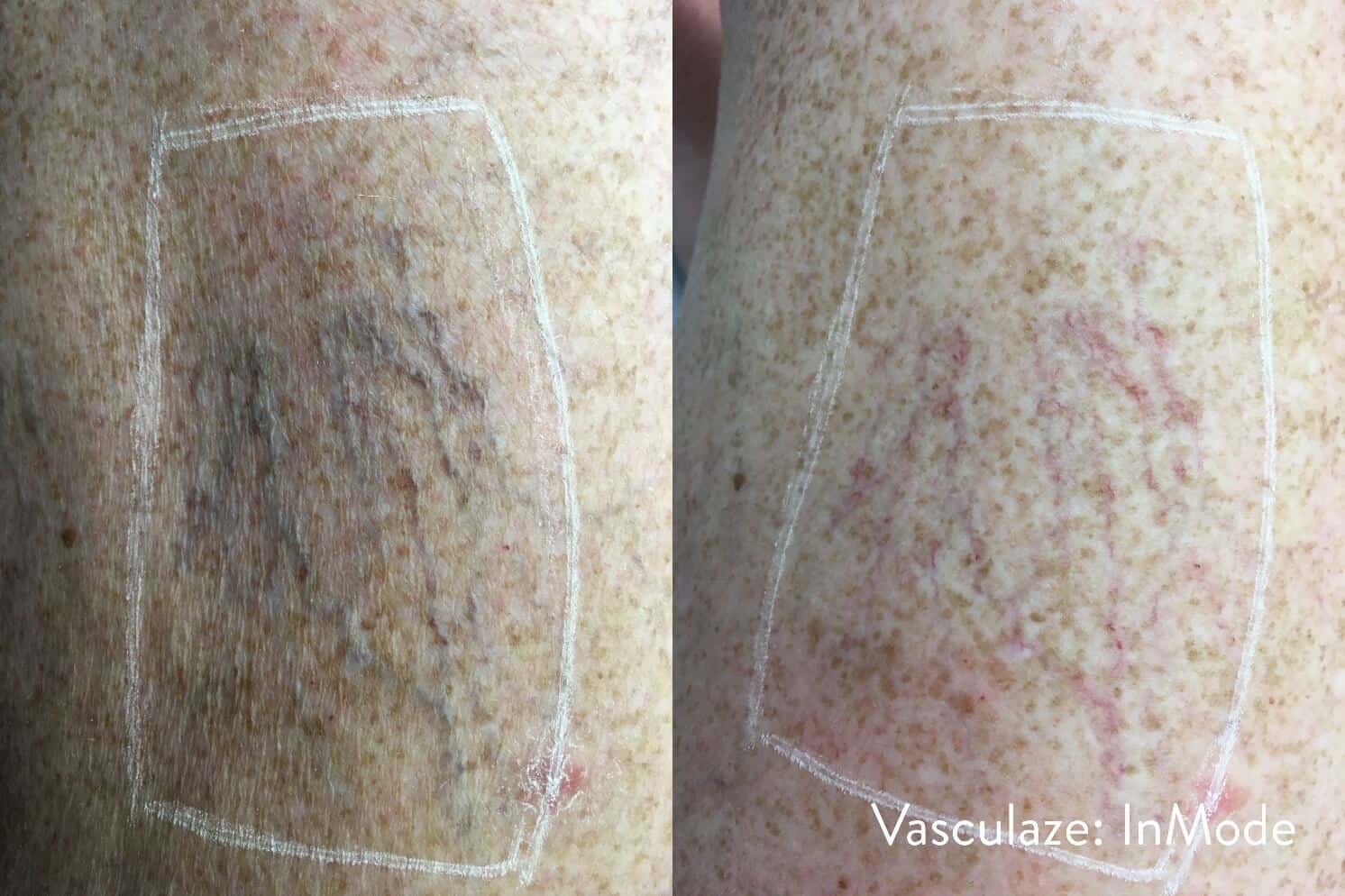 Leg Vein Reduction - Patient Before and After Gallery – Photo 11