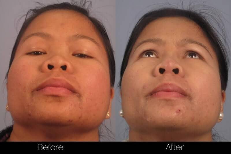 5 Minute Nose Job - Before and After Gallery – Photo 12