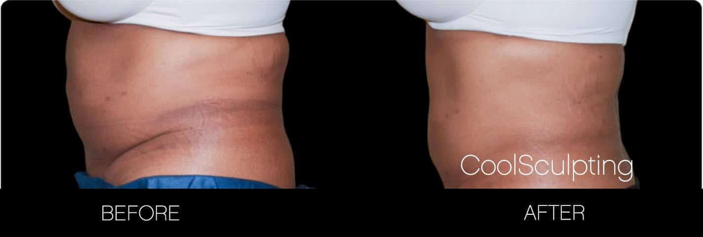 CoolSculpting - Before and After Gallery – Photo 12