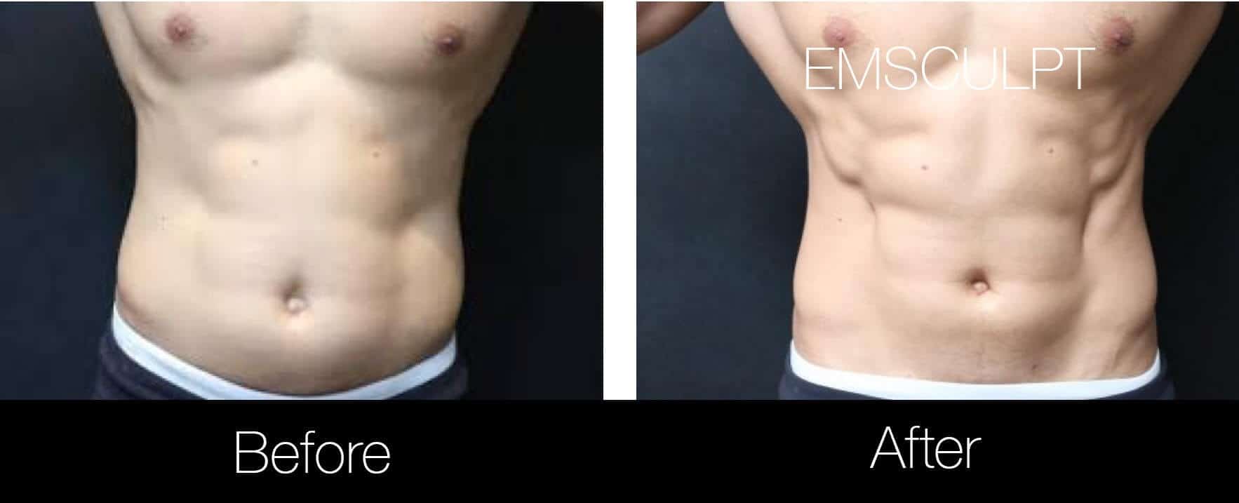 Emsculpt - Before and After Gallery – Photo 12