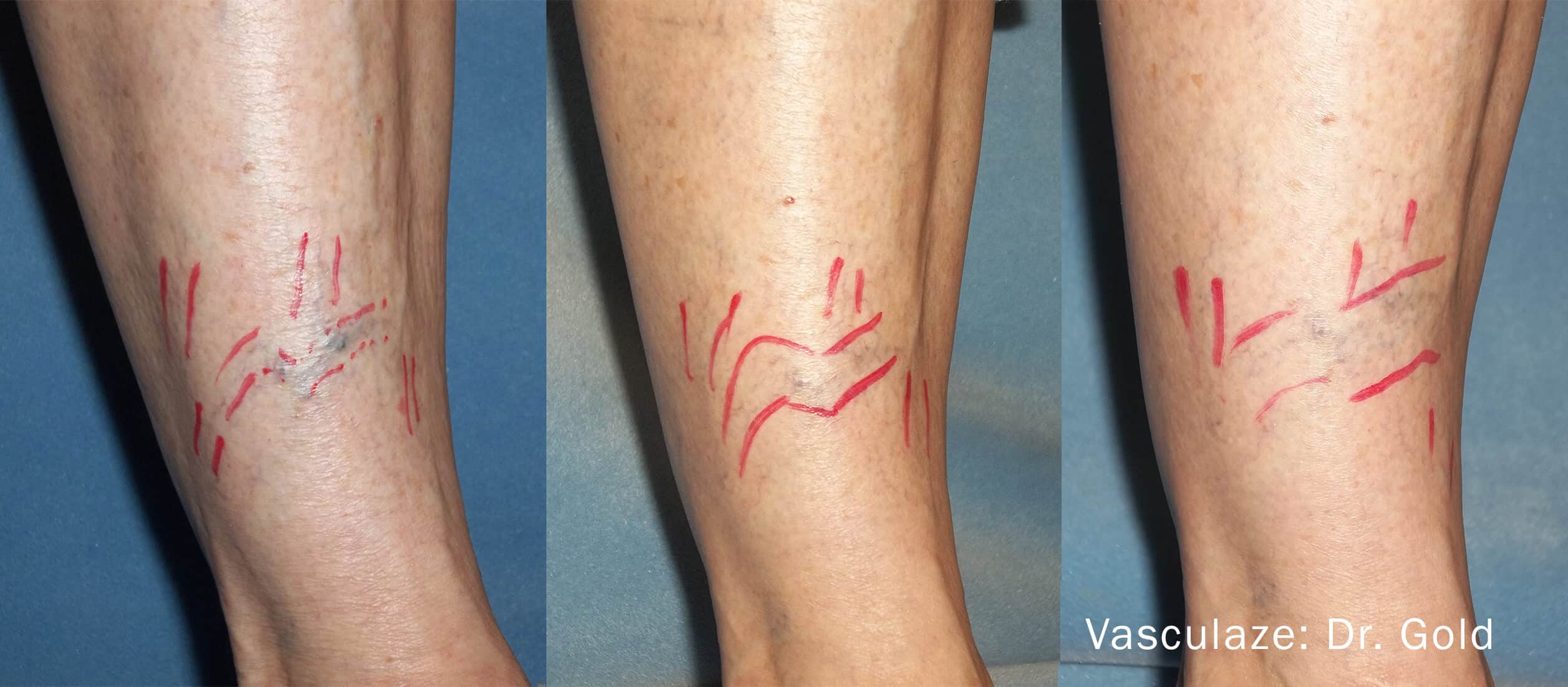 Leg Vein Reduction - Patient Before and After Gallery – Photo 12