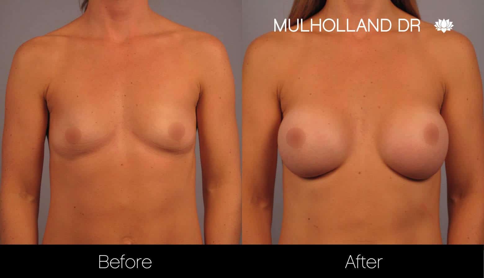 Breast Augmentation - Before and After Gallery – Photo 12