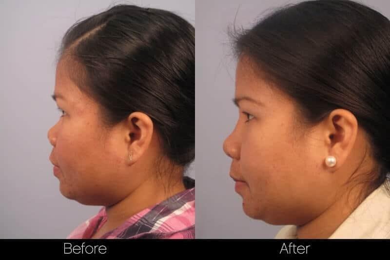 5 Minute Nose Job - Before and After Gallery – Photo 13